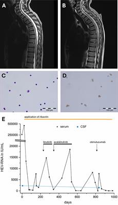 Chronic hepatitis E virus-induced spinal cord atrophy in a patient with chronic lymphatic leukemia: a case report and interdisciplinary management proposal